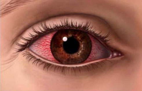التغيير في لون العين علامة لوجود خلل بالجسم ! Olho-vermelho-isoolhos-com-br